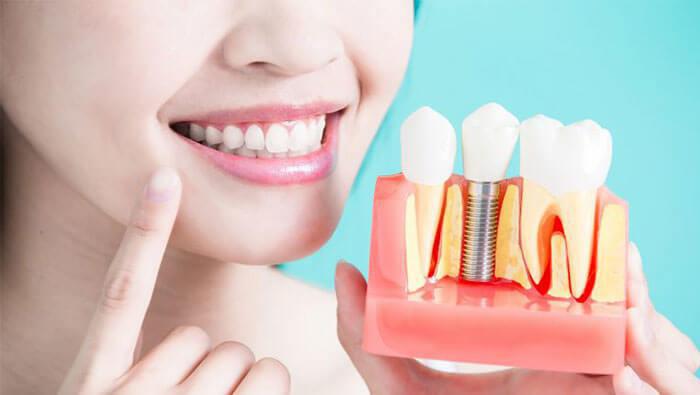 مراحل ایمپلنت دندان و مهارت پزشک در هر بخش