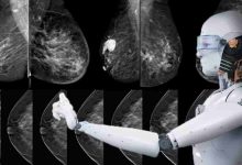 هوش مصنوعی در تشخیص سرطان پستان