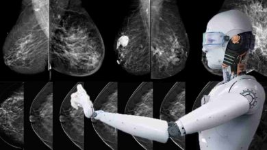 هوش مصنوعی در تشخیص سرطان پستان